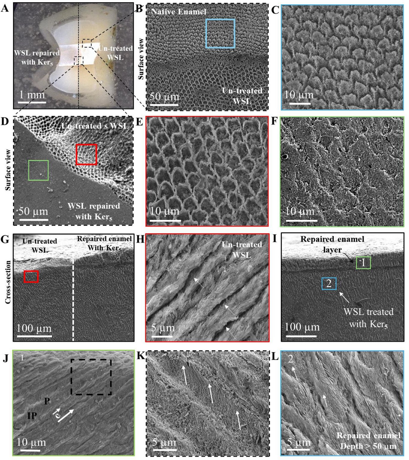 SEM figure of keratin-repaired enamel from Biomimetic Mineralization of Keratin Scaffolds for Enamel Regeneration